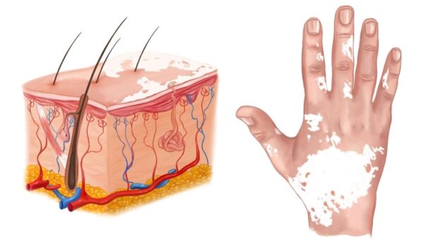 Vitilinox: Treatment for Vitiligo and Skin Repigmentation